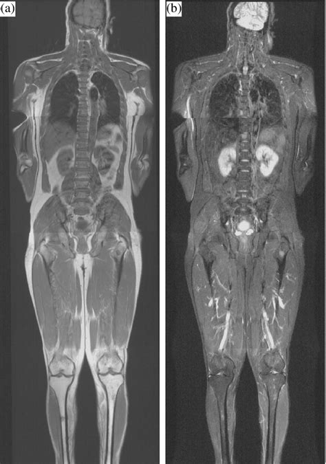 Whole Body Mri On T1se A And Stir B Images Download Scientific