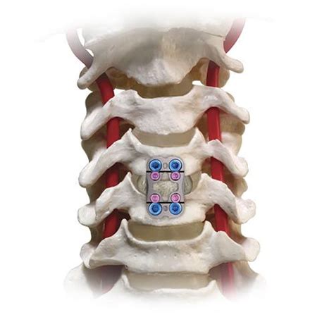 Anterior Cervical Discectomy Fusion Globus Medical