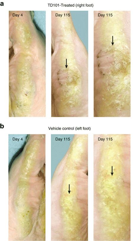 Improvement Of Pachyonychia Congenita Symptoms Following TD101