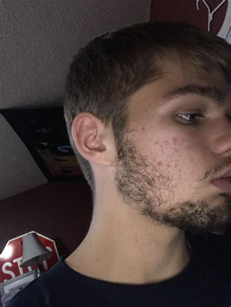 Patchy Beard Growth Progress | Beard on Brother