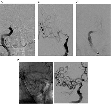 Frontiers Rescue Endovascular Treatment For Emergent Large Vessel