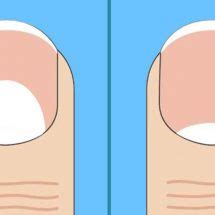 The Moons On Your Nails Can Indicate These 13 Health Problems