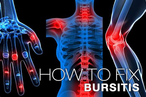 Bursitis Symptoms Causes Treatment By Bursitis Braces