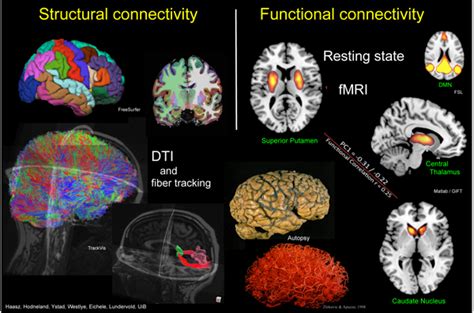 Structural and functional connectivity assessed with multimodal MRI... | Download Scientific Diagram