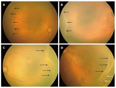 Retinopathy Of Prematurity Stages And Zones