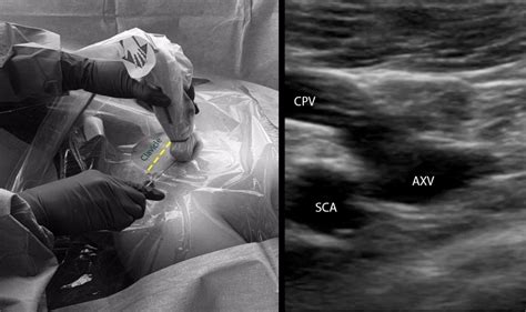 Tips And Tricks US Guided Subclavian Vein EM Ultrasound Section