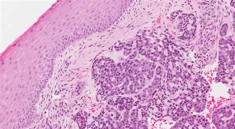 Basaloid Squamous Cell Carcinoma Of The Larynx Ottawa Atlas Of Pathology