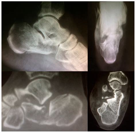 Jcm Free Full Text Delayed Surgical Treatment Of Displaced Intra