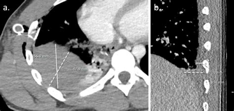 Ct Based Pleural Effusion Volume Estimation Formula Demonstrates Low Accuracy And