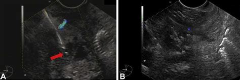 Feasibility Of Eus Guided Nd Yag Laser Ablation Of Unresectable