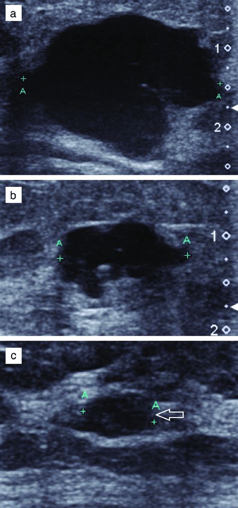 A 65 Year Old Woman With Invasive Ductal Carcinoma Idc Grade Iii In