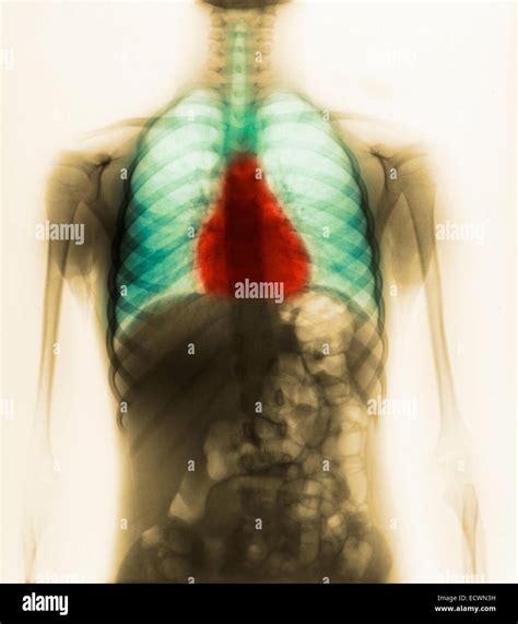 Radiographie Thoracique Normale Banque De Photographies Et Dimages