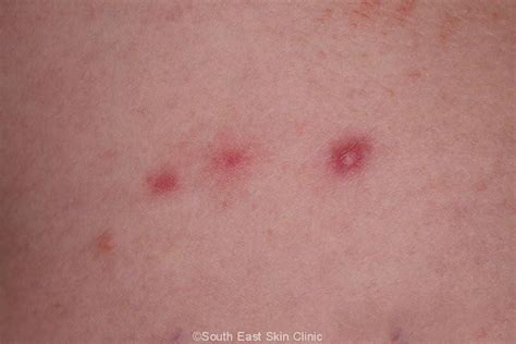 Folliculitis - A term many Australians are familiar with but why?