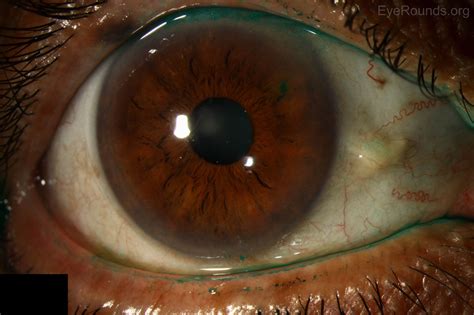 Superior Limbic Keratitis