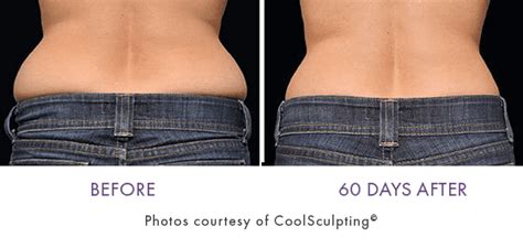 Coolsculpting® In Reading Pa Berks Plastic Surgery