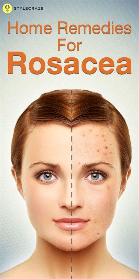 10 Natural Remedies To Manage Rosacea Types Symptoms And Causes