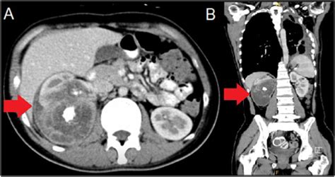 Contrasted CT scan in axial (A) and coronal (B) plane showing right ...