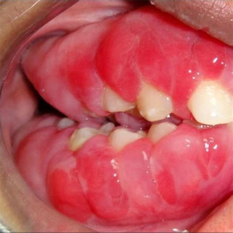 Gingival Enlargement 2 Months After Pregnancy Frontal View