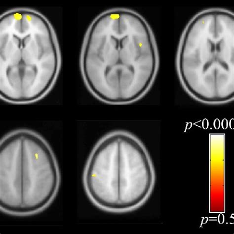 Voxel Wise Whole Brain Voxel Based Morphometry Results Of The Gm Shown