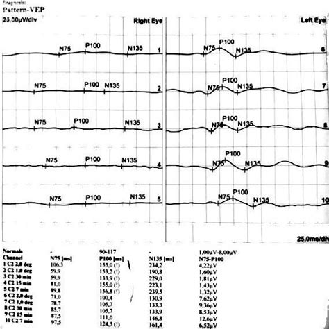 Optic disc edema in right fundus and normal apperence of left optic ...