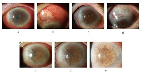 Photograph Of The Anterior Segment Of The Left Eye Fig 1a B Scleral