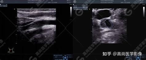 颈动脉狭窄的超声诊断【高尚医学影像】 知乎