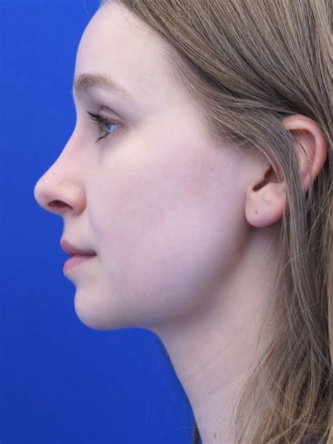 Cases In Rhinoplasty Endonasal Mao Facial Plastics