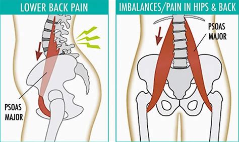 The ‘psoas Syndrome Chiropractic And Physiotherapy Health Centre