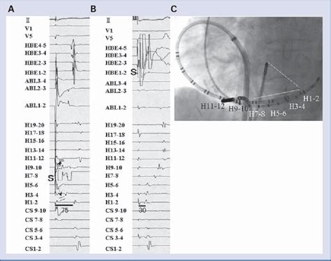 Figure From Typical Atrial Flutter With Atypical Flutter Wave