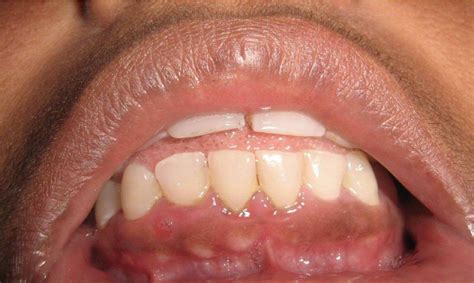 Case 1 Showing Multiple GFNs On The Mandibular Anterior Muco Gingival