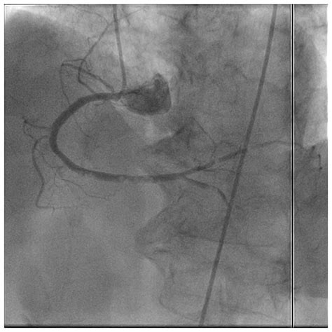 Massive Right Coronary Air Embolism In The Right Coronary Artery During