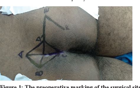 Figure 1 From Rhomboid Excision And Limberg Flap Operation For Managing