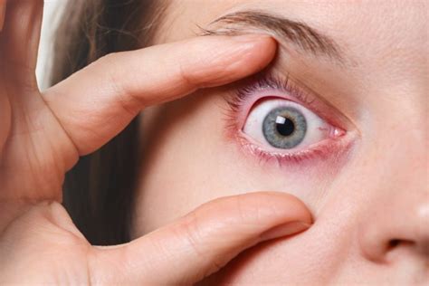 The Quickest And Easiest Way To Get Rid Of A Chalazion Laura Crawley