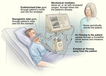 Mechanical Ventilation: Conventional & Non-Conventional | Study.com