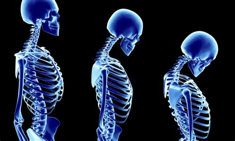 Osteoporoz Kemik Erimesi Nedir Belirtileri Tan Ve Tedavisi