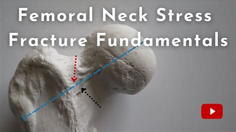 Femoral Neck Stress Fractures What You Need To Know Youtube