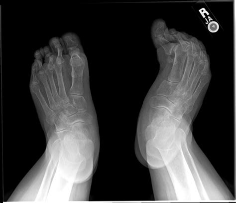 Rheumatoid Arthritis Feet Xray