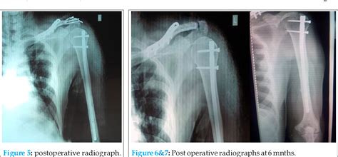 Figure 5 From Acromioclavicular Joint Dislocation With Ipsilateral Mid Third Clavicle Mid Shaft