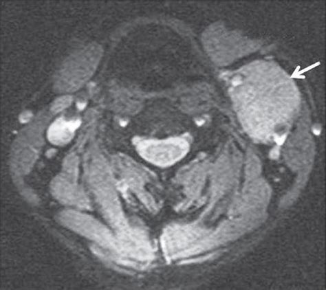 Axial Gradient Recalled Echo Mri Of Neck Showing Mass At The Carotid