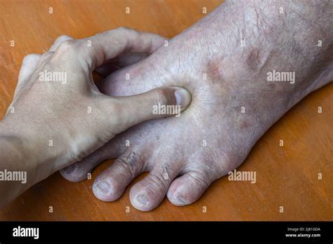 Pitting Edema Hand