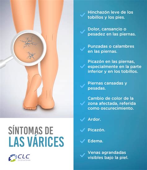 Masajes Para Las Varices En Las Piernas Off