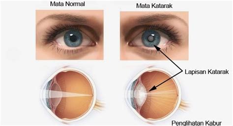 Gejala Penyebab Dan Pengobatan Penyakit Katarak Pada Anak Dan Lansia