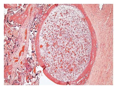 An Adrenocortical Heterotopia Located In Subchorionic Space Described