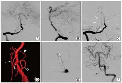 Case Right Vertebral Artery Va Angiogram A And B Obtained At