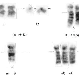 Examples of chromosomal abnormalities: (a) translocation (9,22) ; (b ...