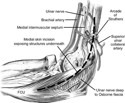 Ulnar Nerve Subluxation