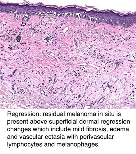 Pathology Outlines Staging