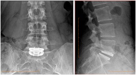 Lumbar Arthroplasty Westmead NSW ACDF Wahroonga NSW