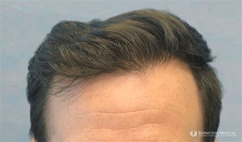 Patient Kjc Bernstein Medical Center For Hair Restoration