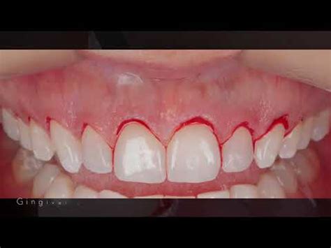 Crown Lengthening Macro View Aumento De Coroa Clinica Youtube